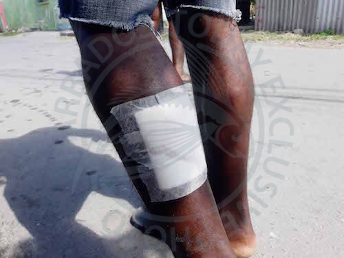 A young resident of New Orleans who was shot in his calf in a recent gun attack.